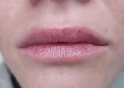 Kosmetische Lippenvollschattierung Behandlung vorher