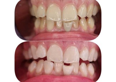 Kosmetische Zahnaufhellung und Zahnreinigung - Ergebnis vorher nachher bei mAdame Kosmetik aus Rottenburg