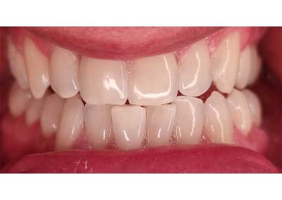 Zahnkosmetik Ergebnis nach Bleaching Behandlung von Kosmetikerin Inna Adam aus Rottenburg